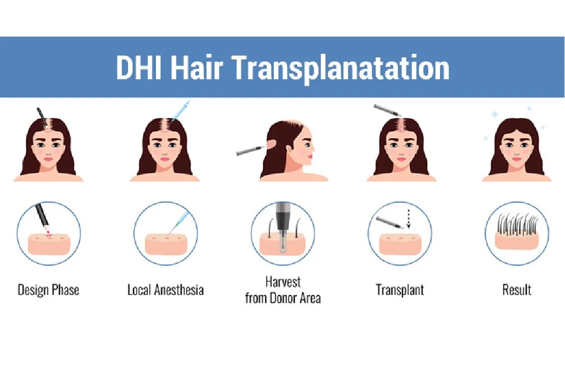 unshaven female hair transplant paradisee clinic istanbul