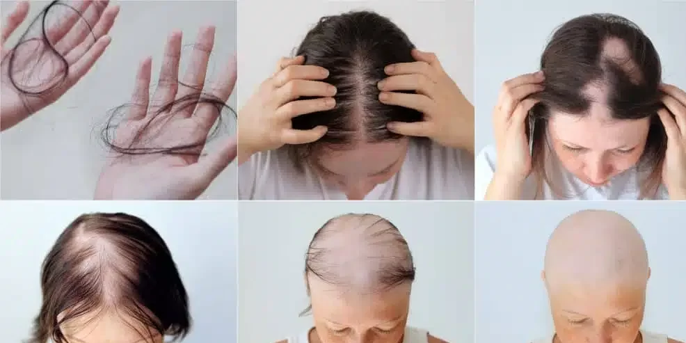 female hair loss