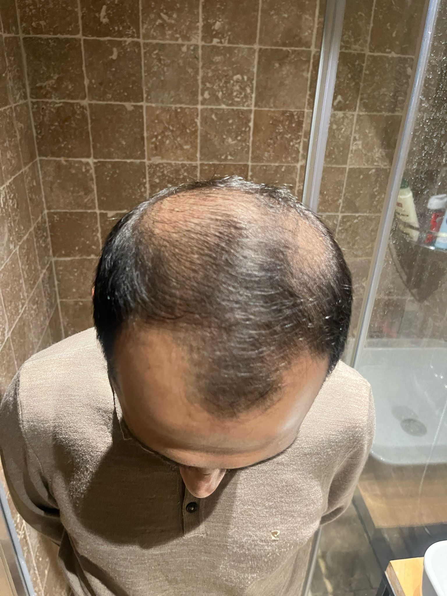 Mr Zafer's 8th months results is here . He had 5500 hair grafts in a single session with DHI method .