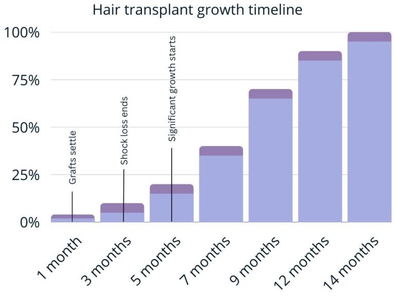 after a hair transplant growth timeline