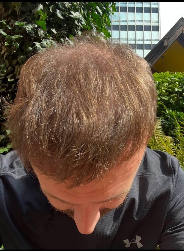 4000 grafts dhi 8 months after result