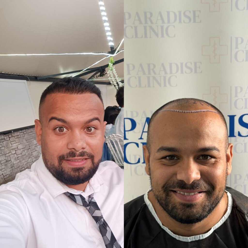 Front area transplant result 4000 hair graft at paradise clinic